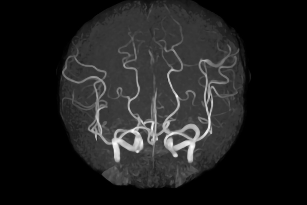 頭部MRA