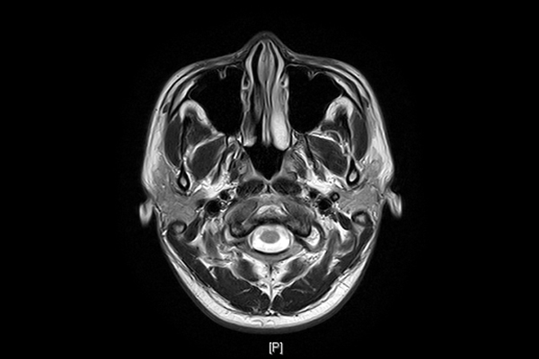 頭部MRI