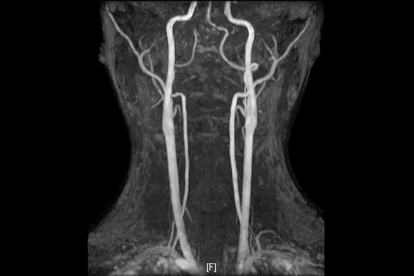 頚部MRA